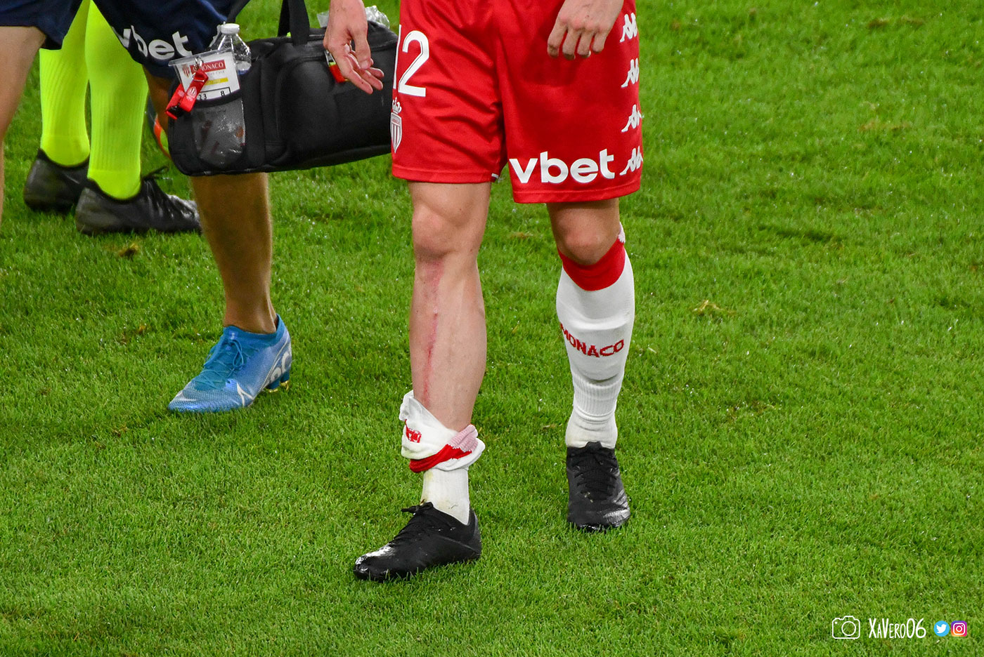 Le tibia de Caio Henrique bien marqué